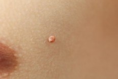 Tahi Lalat Mengganggu ? Berikut Cara Menghilangkan Tahi Lalat dengan Bahan Alami 