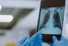 Mengerikan! 154 Anak di Kota Bogor Terjangkit TBC, Dinkes Catat 14 Jiwa Meregang Nyawa